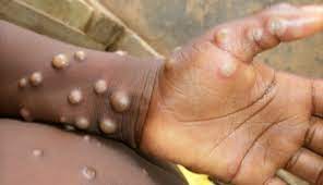 Monkeypox Cases Top 35,000 In 92 Countries￼ 