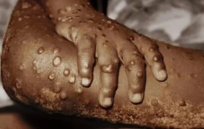 Mpox: Nigeria Begins Vaccination August 8