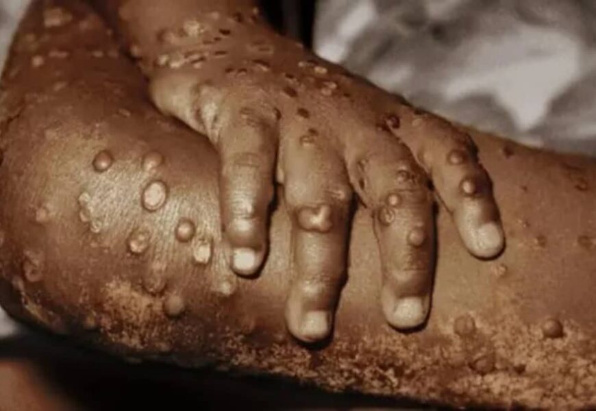 Mpox: Nigeria Begins Vaccination August 8